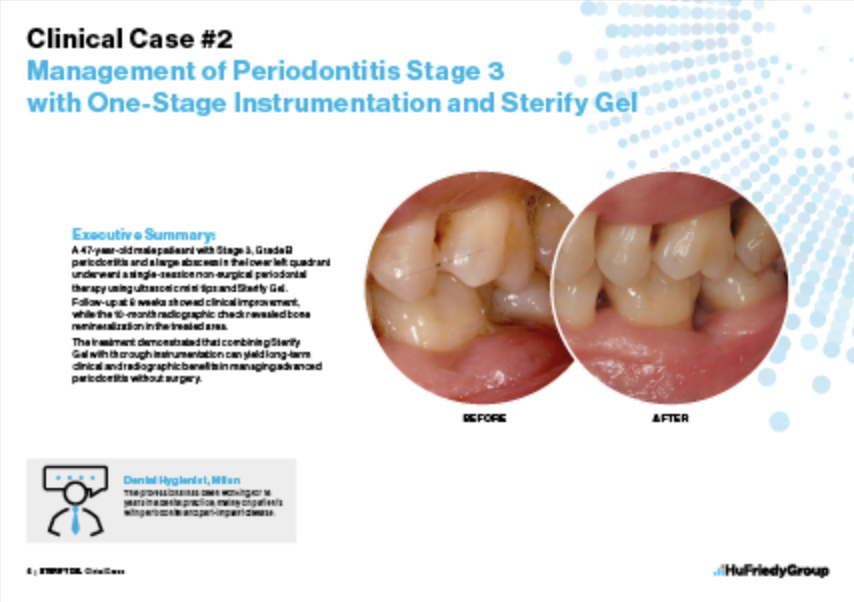 Management of Periodontitis Stage 3 with One-Stage Instrumentation and Sterify Gel