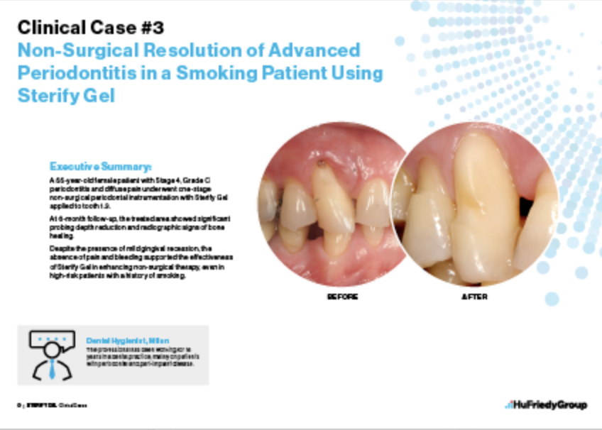 Non-Surgical Resolution of Advanced Periodontitis in a Smoking Patient using Sterify Gel