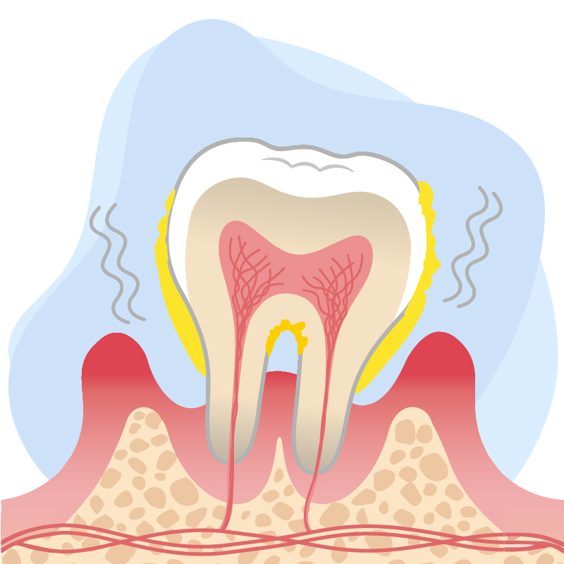 Hard and soft deposits removal from the tooth surface