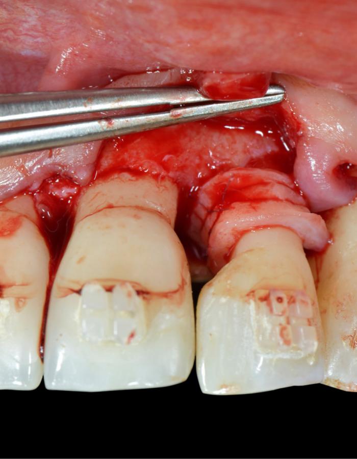 SwissPerio Live Surgery SwissPerio Live Surgery